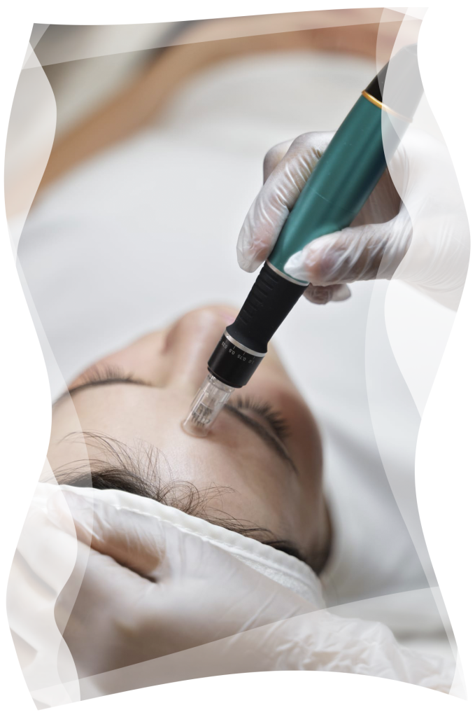 microneedeling